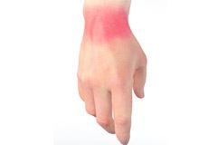 Wrist Sprain